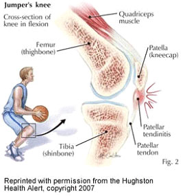 Patellar Tendinopathy